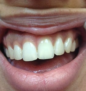 Case Study - Cosmetic Dentistry After Image