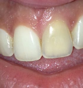 Case Study - Cosmetic Dentistry Before Image