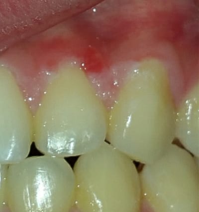 Laser Smile Correction – Case 4