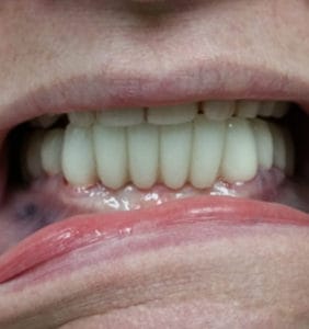 Case Study - Cosmetic Dentistry After Image