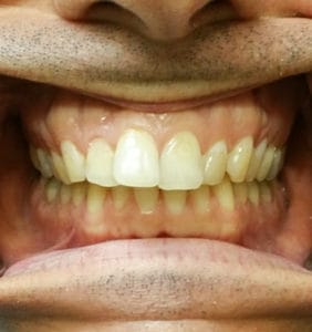 Case Study - Cosmetic Dentistry Before Image