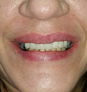 Case Study - Cosmetic Dentistry After Image