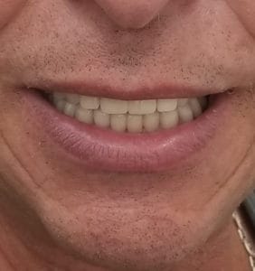 Case Study - Dental Implant After