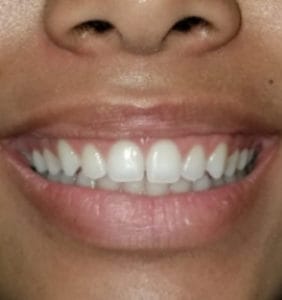 Case Study - Cosmetic Dentistry After Image