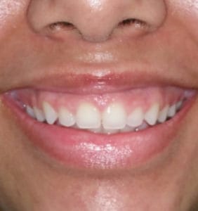 Case Study - Cosmetic Dentistry Before Image