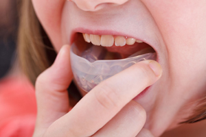 Child wearing mouth guard - Clock Tower Dental