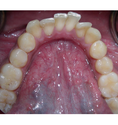 Orthodontics Case 10