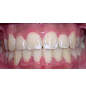 Case Study - Cosmetic Dentistry After Image
