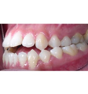 Case Study - Cosmetic Dentistry Before Image