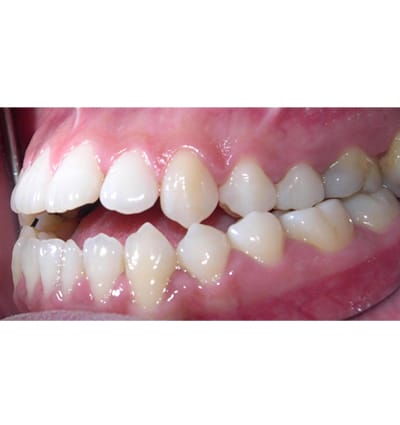 Orthodontics Case 13