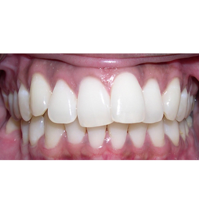 Orthodontics Case 1
