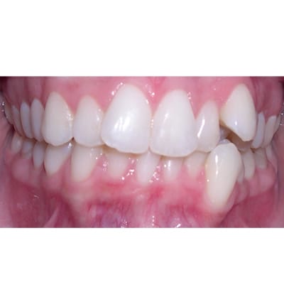 Orthodontics Case 2