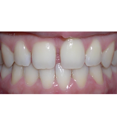 Orthodontics Case 3