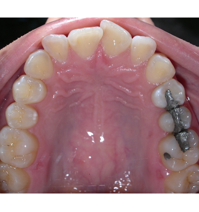 Orthodontics Case 4