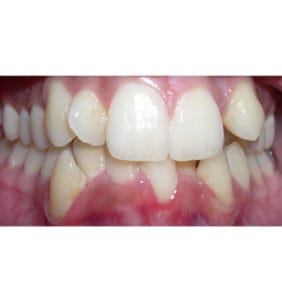 Case Study - Cosmetic Dentistry Before Image