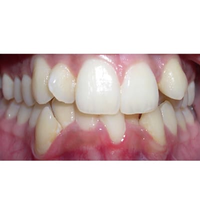 Orthodontics Case 5