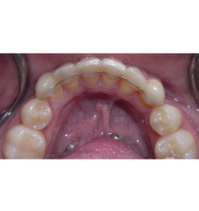 Case Study - Cosmetic Dentistry After Image