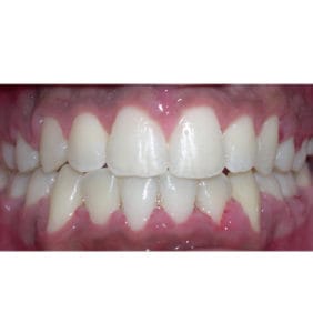 Case Study - Cosmetic Dentistry After Image