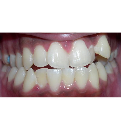 Orthodontics Case 7