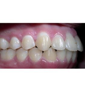 Case Study - Cosmetic Dentistry After Image