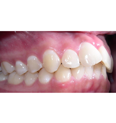 Orthodontics Case 8