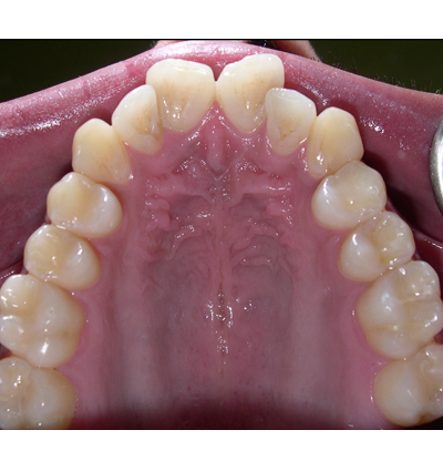 Orthodontics Case 9