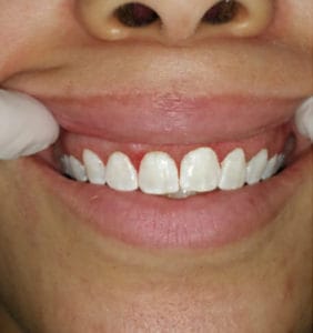 Case Study - Cosmetic Dentistry Before Image