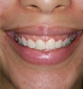 Case Study - Cosmetic Dentistry Before Image