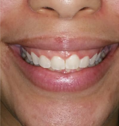 Laser Smile Correction – Case 5