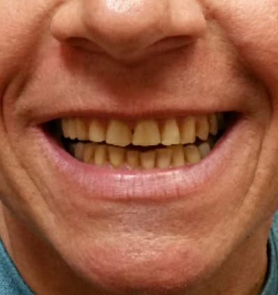 Porcelain Veneers – Case 10