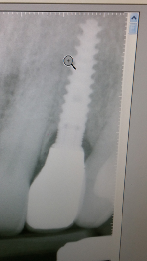 X-ray of dental implant