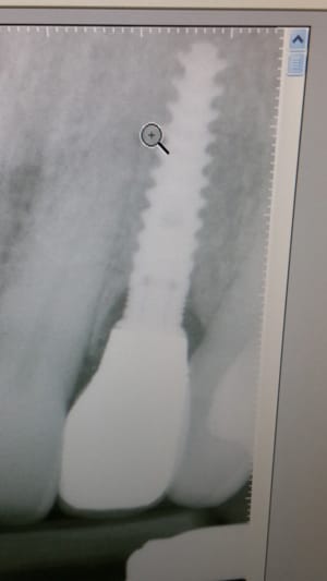 X-ray of dental implant