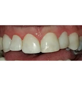 Case Study - Cosmetic Dentistry After Image