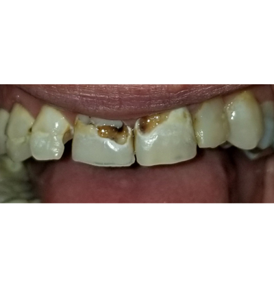 Cosmetic Dentistry – Case 22