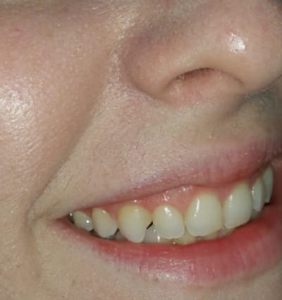 Cosmetic Dentistry – Case 21