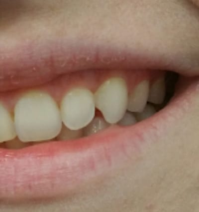 Cosmetic Dentistry – Case 21