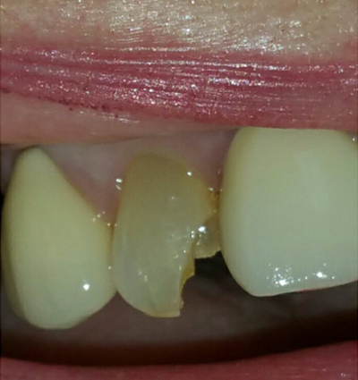 Cosmetic Dentistry – Case 23