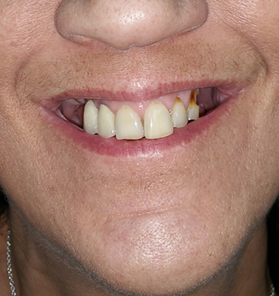 Dental Implants – Case 16