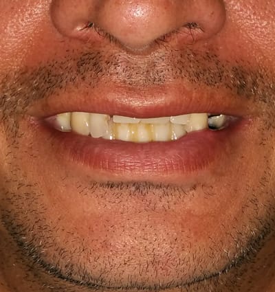 Dental Implants – Case 17
