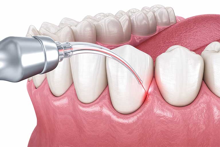 Laser dentistry procedure targeting gum tissue showing precise treatment compared to traditional gum surgery methods