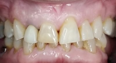 Porcelain Veneers – Case 11