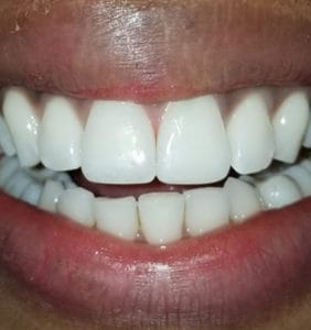 Case Study - Cosmetic Dentistry After Image