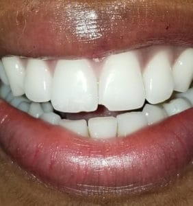 Case Study - Cosmetic Dentistry Before Image