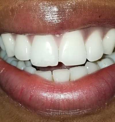 Cosmetic Dentistry – Case 24
