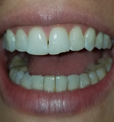 Cosmetic Dentistry – Case 25