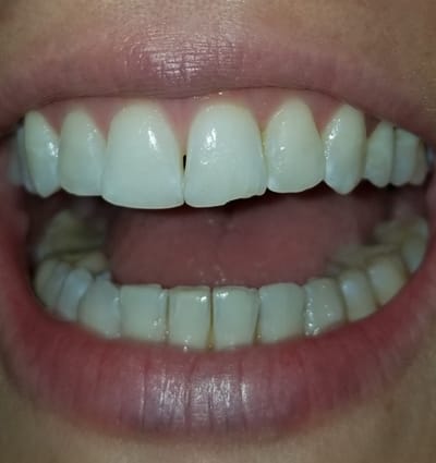 Cosmetic Dentistry – Case 25