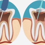 Surgical vs. Non-Surgical Root Canal Therapy | Clock Tower Dental of Franklin Square