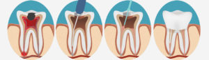 Surgical vs. Non-Surgical Root Canal Therapy | Clock Tower Dental of Franklin Square