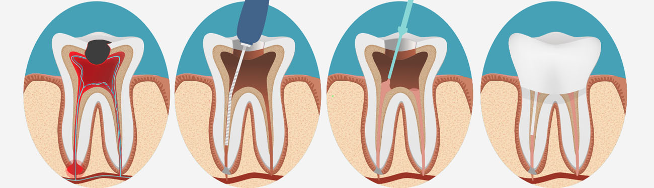 Surgical vs. Non-Surgical Root Canal Therapy
