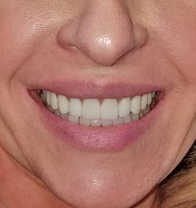 Case Study - Cosmetic Dentistry After Image